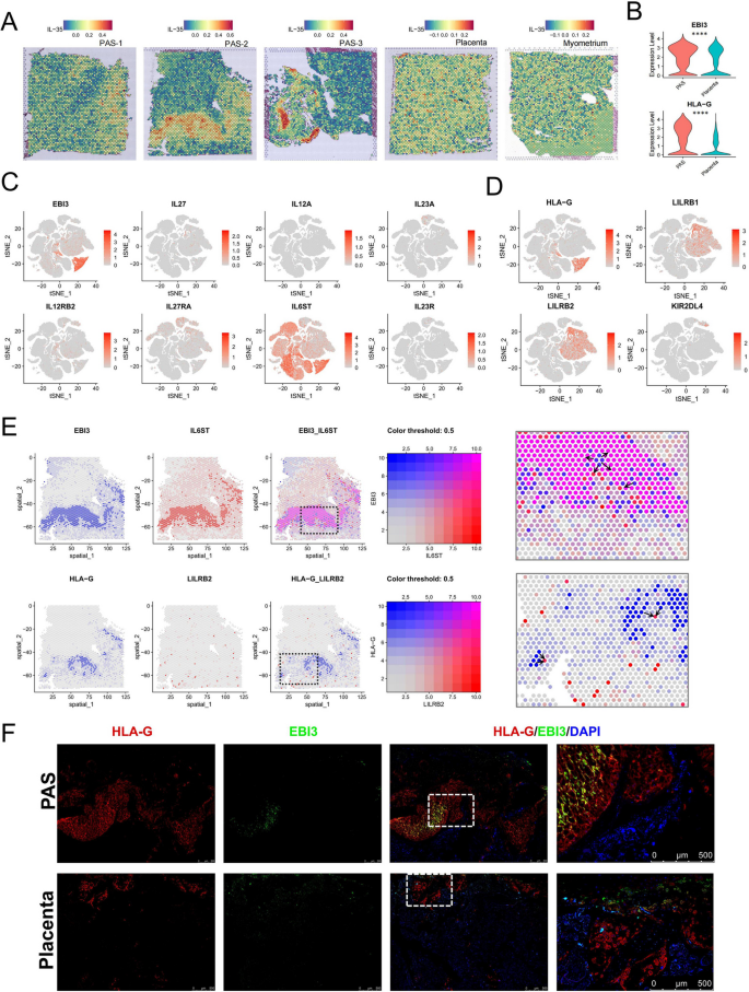 HLA-G/EBI3在PAS EVT的表达