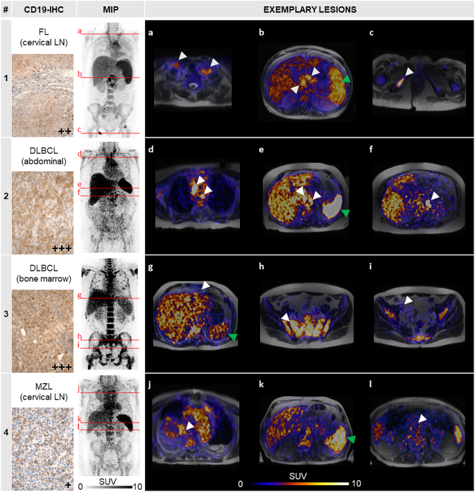 图2 患者⁶⁴Cu-αCD19免疫PET成像结果