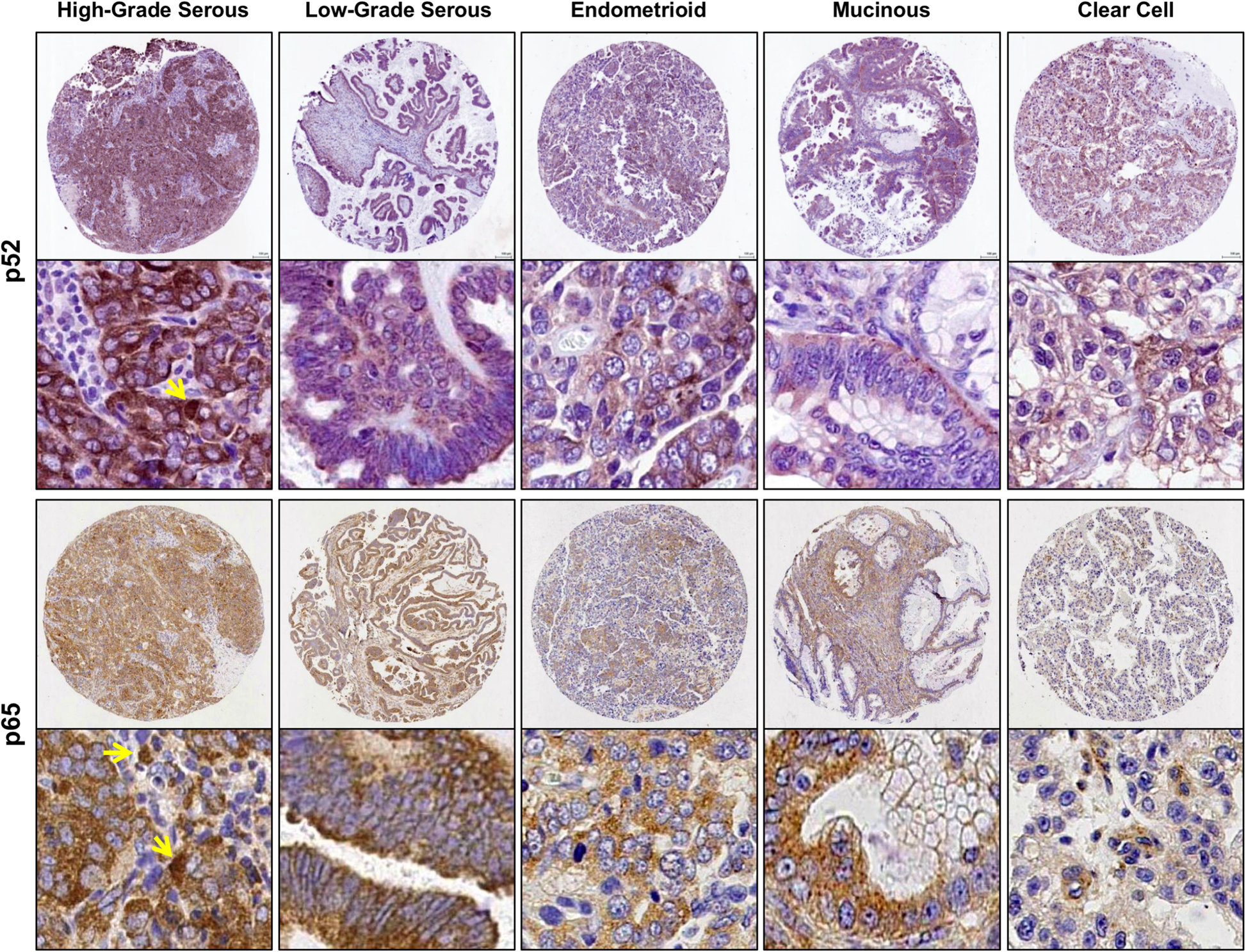 非经典NF-κB转录因子p52的表达与卵巢癌不良预后相关-文献解析