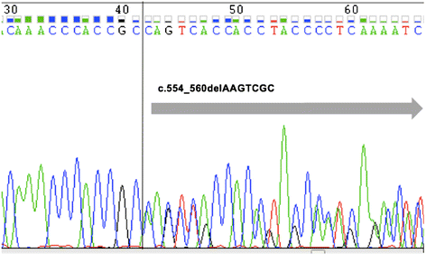 图2 Sanger测序电泳图：显示患者的RUNX1基因7-bp缺失（双峰提示杂合突变）