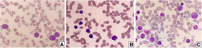 图1 不同治疗阶段的骨髓涂片：a诊断时的 myeloblasts和monoblasts/promonocytes；b诱导化疗后的红细胞发育异常；c移植后的正常造血