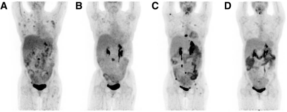 图2 患者治疗前后的PET扫描结果：a 初始诊断时全身代谢活跃灶；b 利妥昔单抗治疗后部分缓解；c 维布妥昔单抗治疗前进展；d 维布妥昔单抗治疗后完全缓解