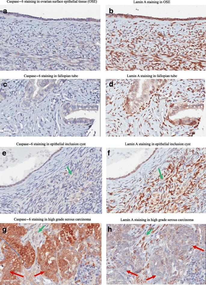 免疫组化显示癌组织中caspase-6升高、lamin A丢失