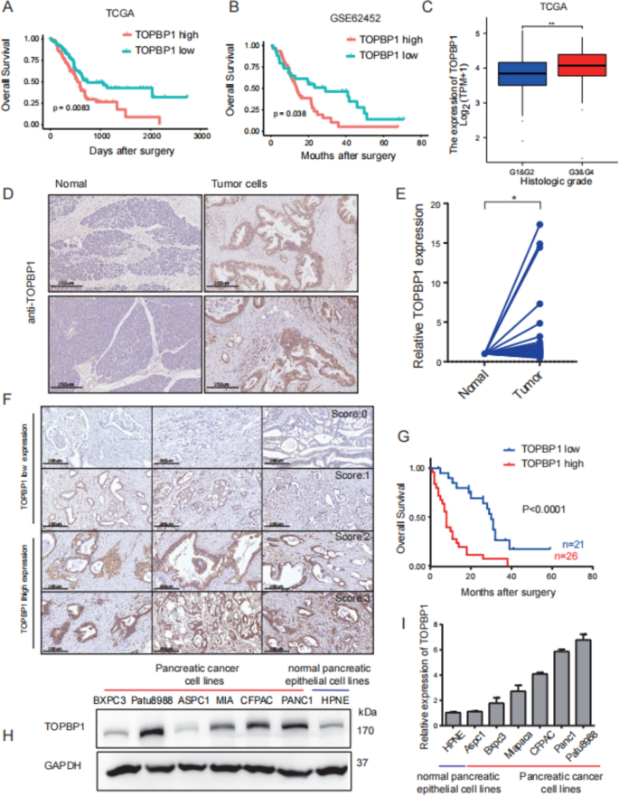 Fig1：TOPBP1在PDAC中的表达及预后关联