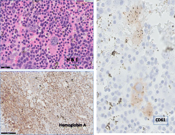 脊柱旁肿块病理图像