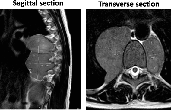 脊柱旁肿块MRI图像