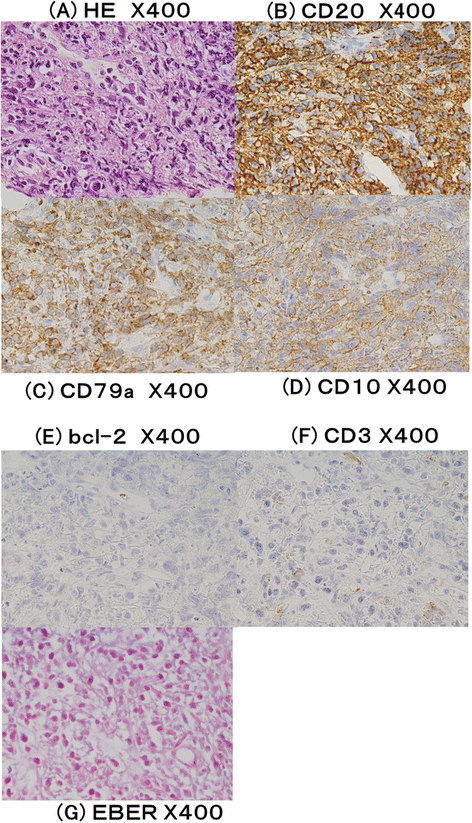 图2 肝肿瘤病理检测结果：HE染色及免疫组化、原位杂交染色