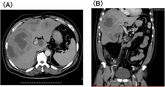 图1 入院时腹部增强CT显示右肝多发不规则结节状肿块