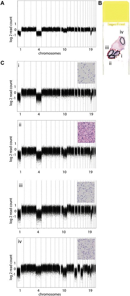 样本LGG240的CNA空间异质性图谱