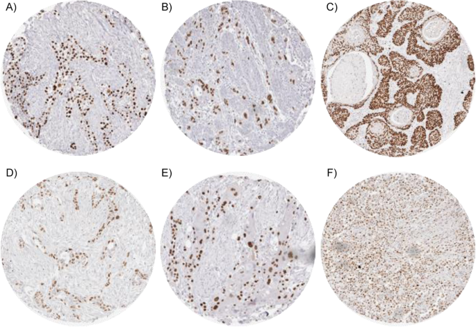 p63在肿瘤组织中的表达:浸润性尿路上皮癌、弥漫型胃癌、肛门鳞状细胞癌、肠型胃癌、伴局灶鳞状分化的胰腺腺癌呈强阳性,弥漫大B细胞淋巴瘤呈中度阳性
