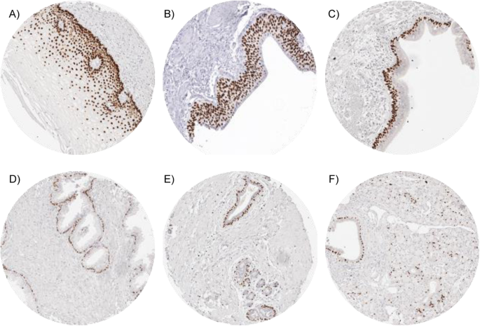 p63在正常组织中的表达:食管鳞状上皮、膀胱尿路上皮、呼吸道上皮基底细胞、前列腺基底细胞、乳腺肌上皮细胞均呈强阳性