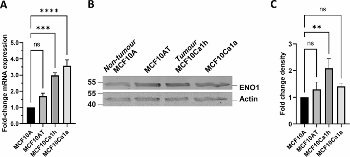 ENO1表达与定位随TNBC恶性程度变化