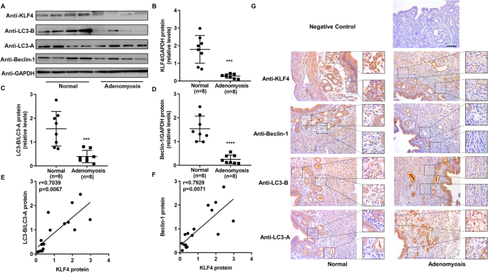 图5 子宫腺肌病模型小鼠子宫中KLF4与自噬标志物的异常表达