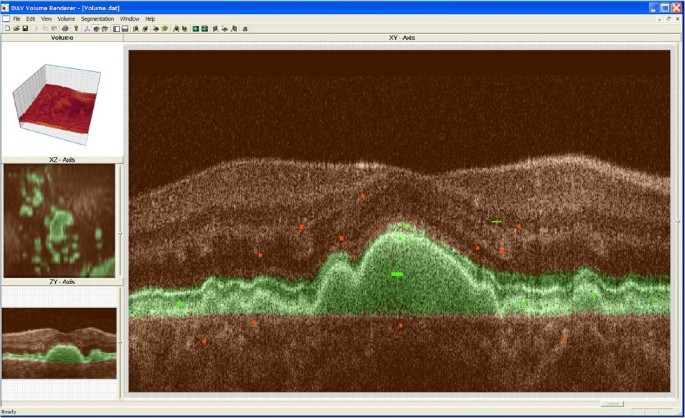 Figure 8：基于SVM的视网膜光学相干断层扫描数据交互式分割界面，绿色标记为感兴趣区域
