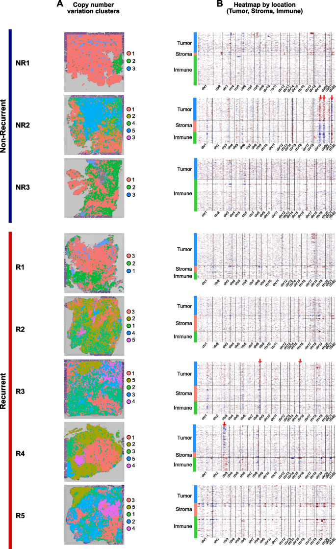 Fig.3 HGSOC空间拷贝数变异分析