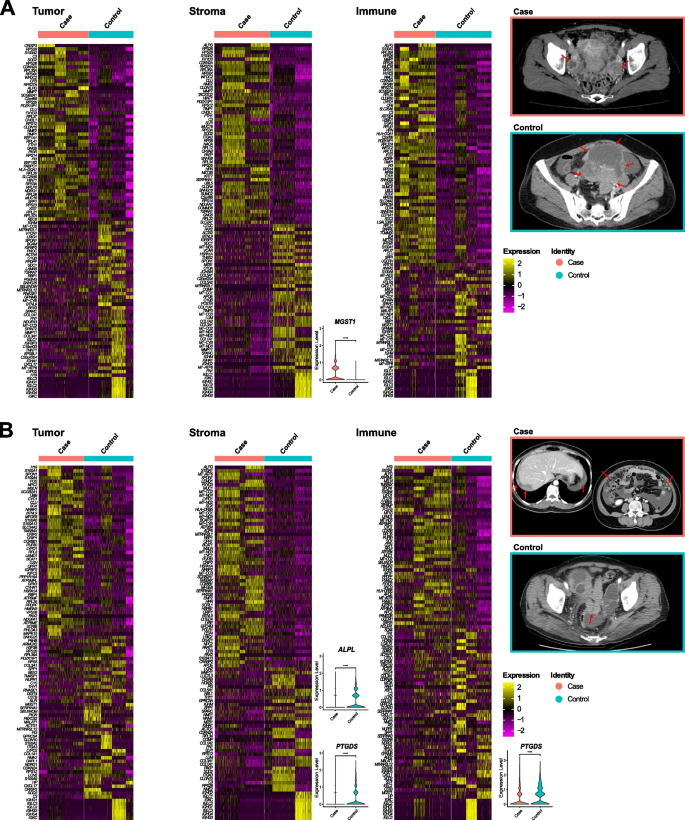 Fig.5 HGSOC放射基因组学关联分析