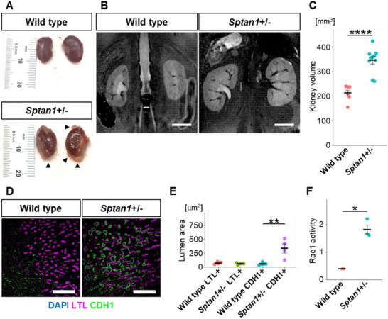 FIGURE 4 Sptan1+/-小鼠出现ARPKD样肾囊性表型